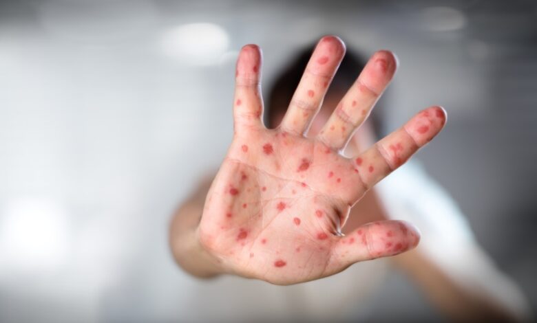 Rumıniyada qızılca epidemiyası elan olunub